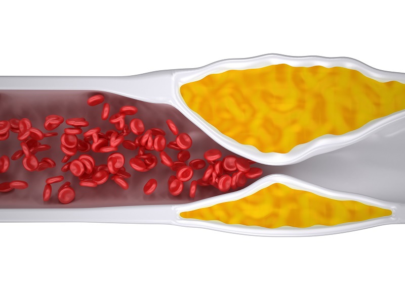 Clogged_artery_by_cholesterol