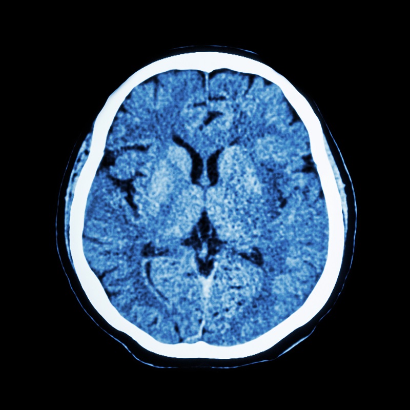 CT_scan_of_brain_2